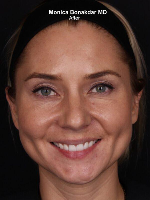 Injectable Treatments Before & After Photo