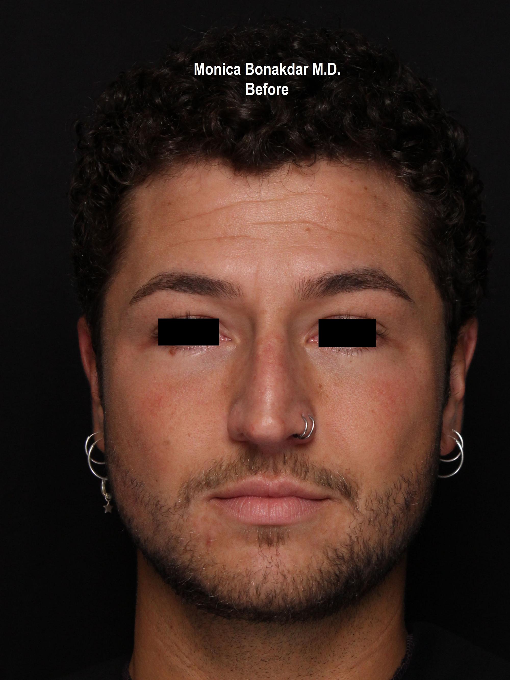 Injectable Treatments Before & After Photo