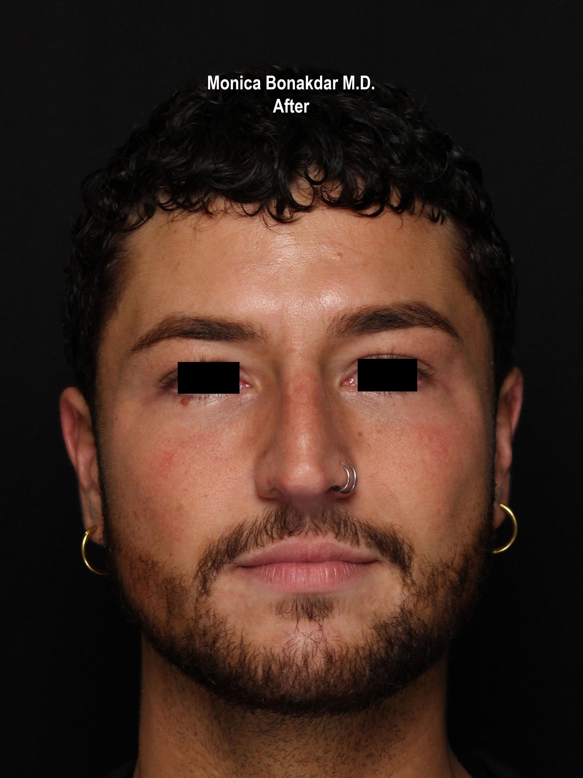 Injectable Treatments Before & After Photo