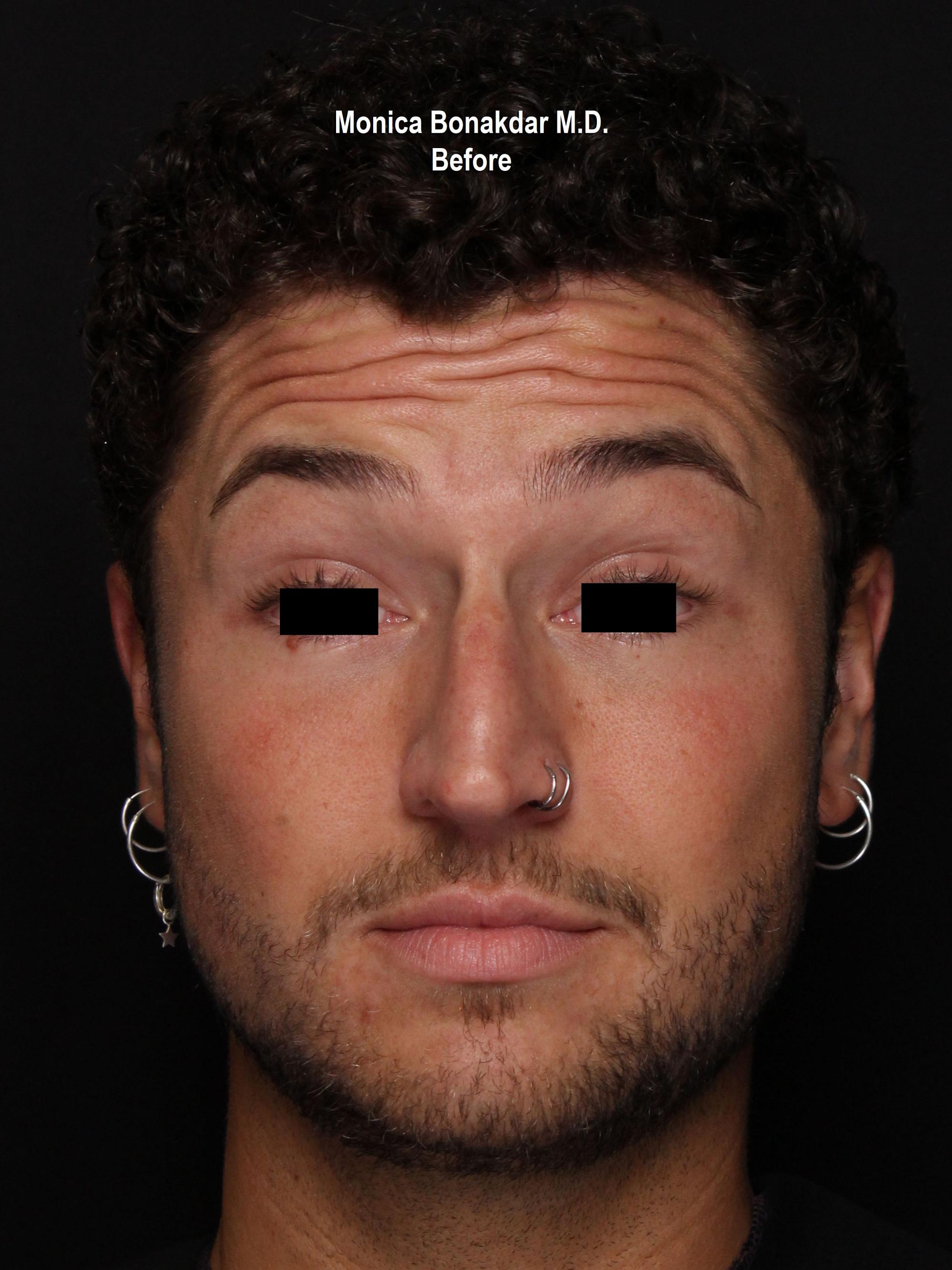 Injectable Treatments Before & After Photo