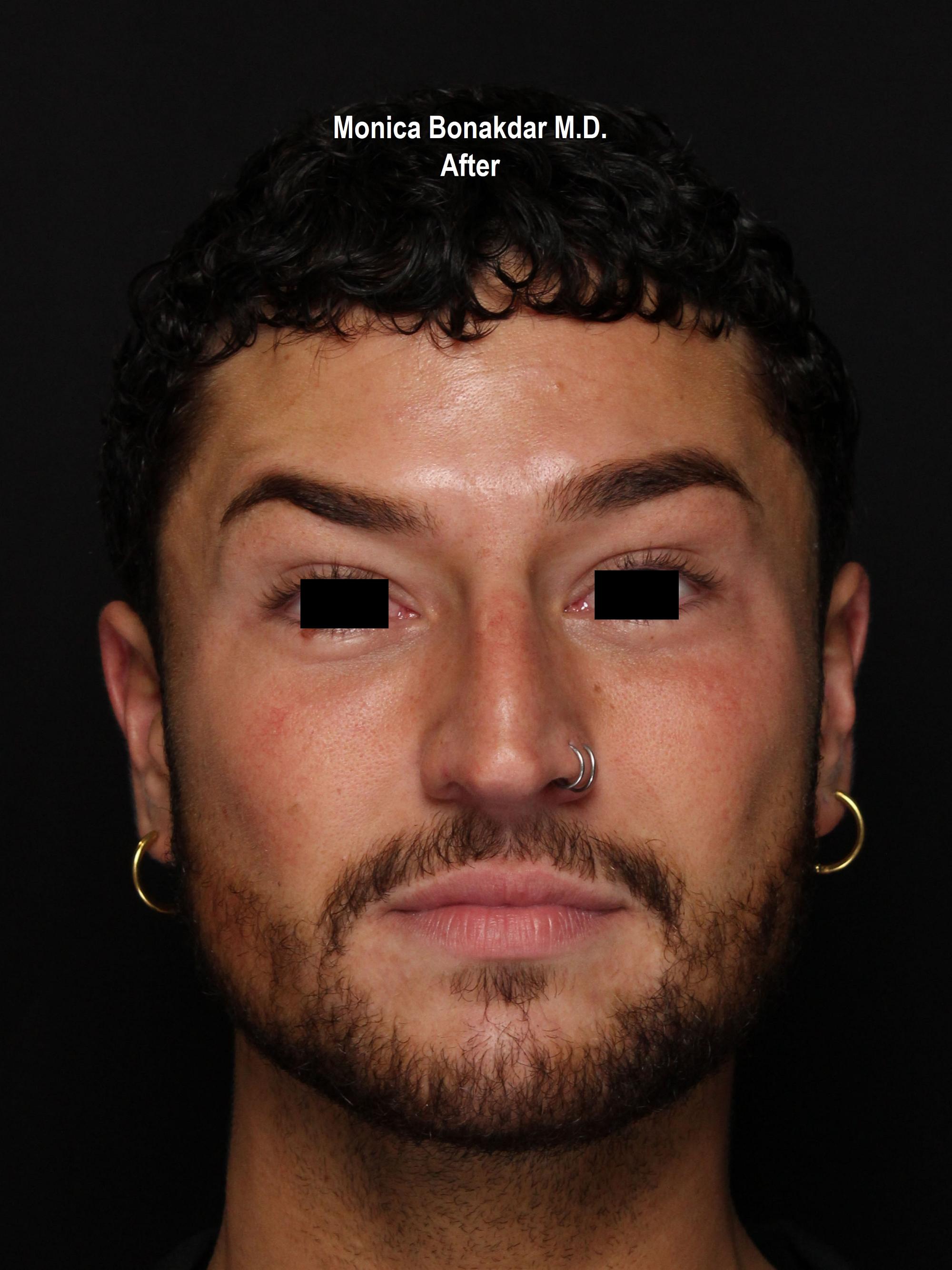 Injectable Treatments Before & After Photo