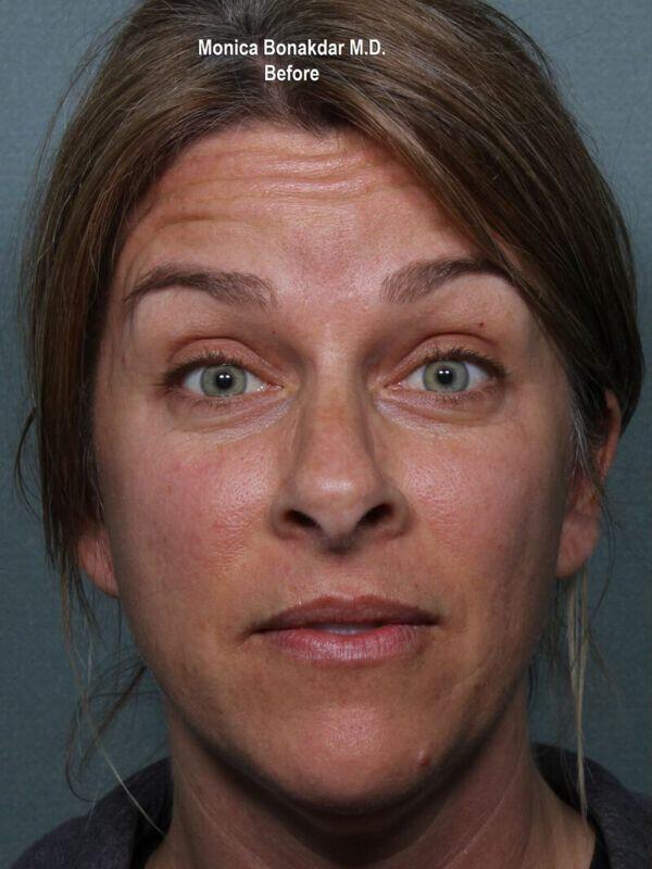 Injectable Treatments Before & After Photo