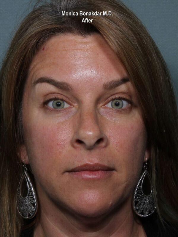 Injectable Treatments Before & After Photo