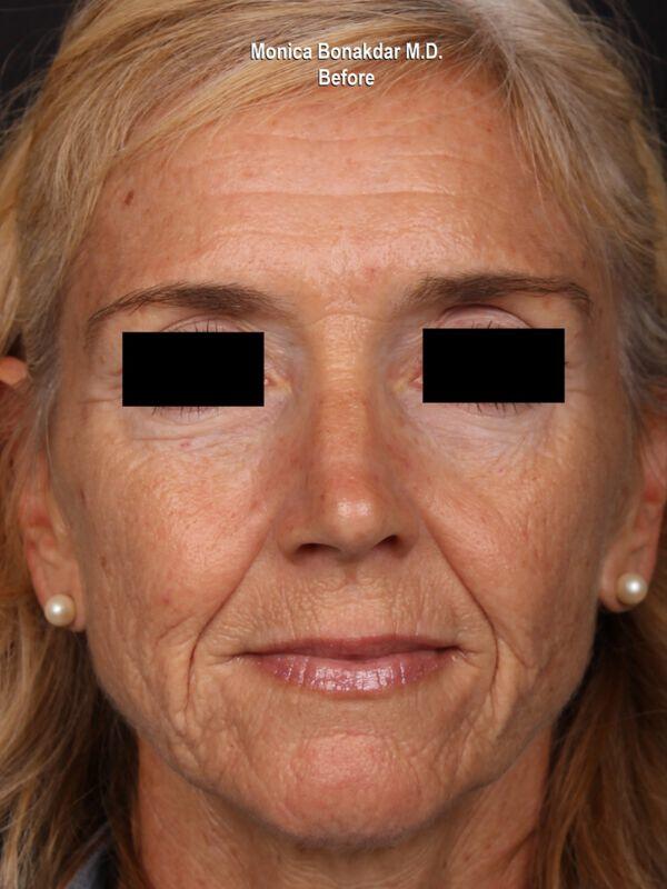 Injectable Treatments Before & After Photo