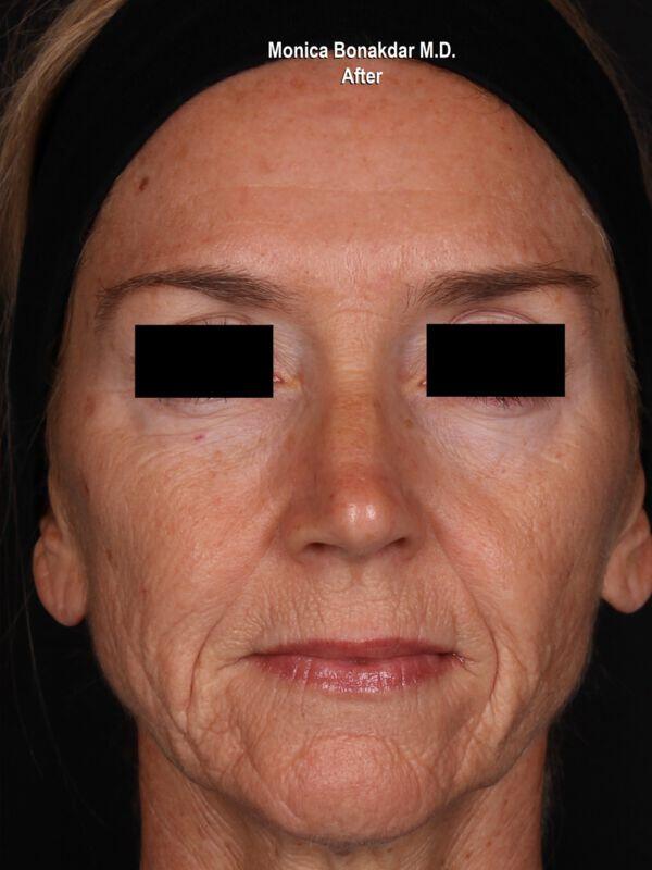Injectable Treatments Before & After Photo