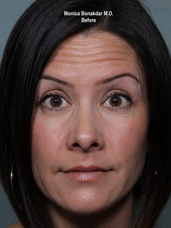 Injectable Treatments Before & After Photo