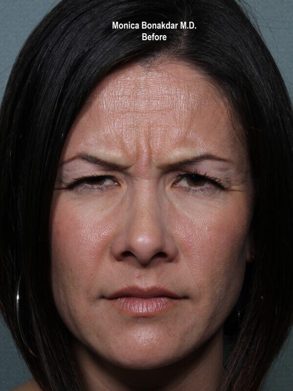 Injectable Treatments Before & After Photo