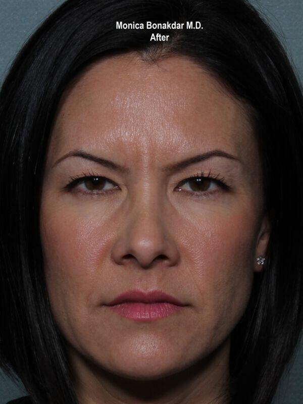 Injectable Treatments Before & After Photo