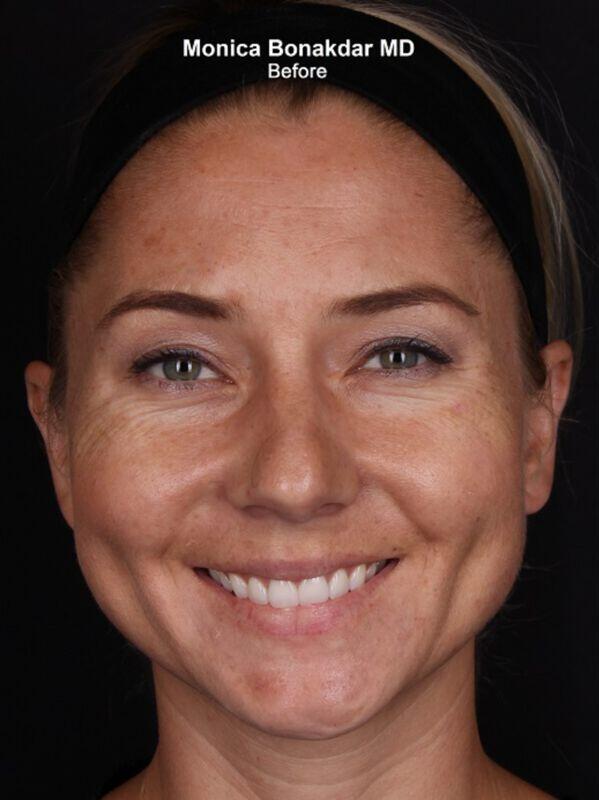 Injectable Treatments Before & After Photo