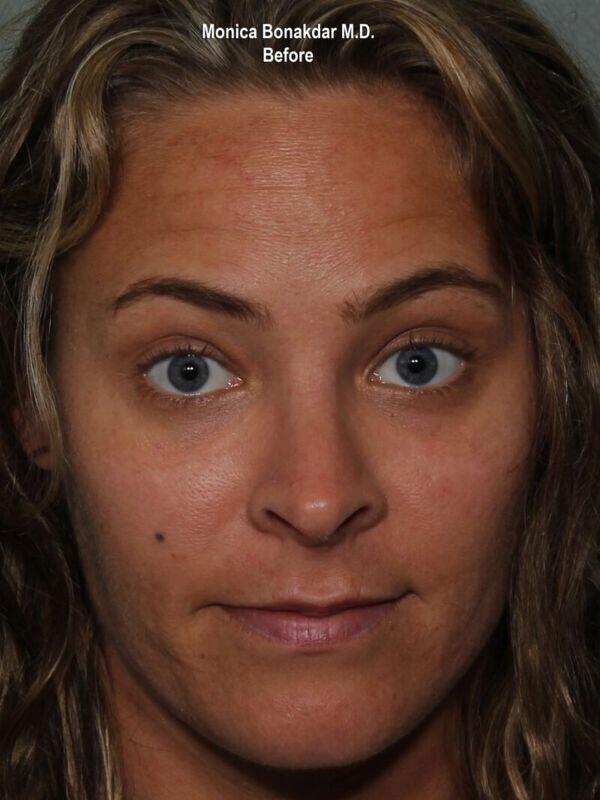 Injectable Treatments Before & After Photo