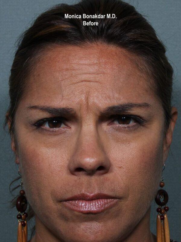 Injectable Treatments Before & After Photo
