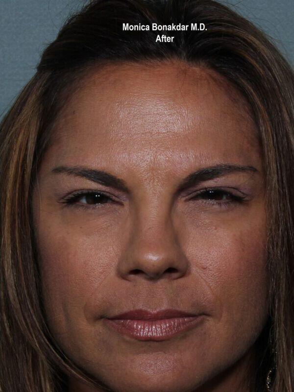 Injectable Treatments Before & After Photo