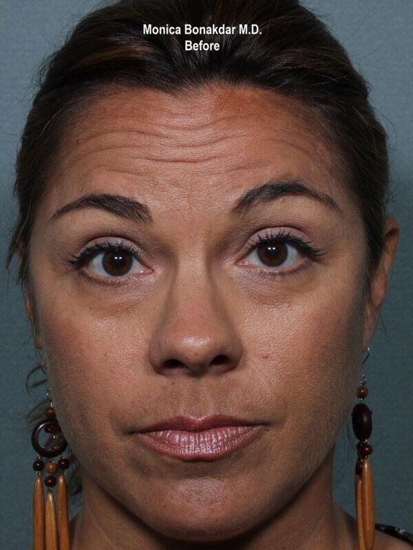 Injectable Treatments Before & After Photo
