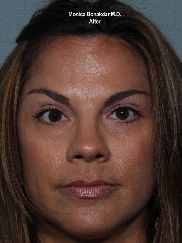 Injectable Treatments Before & After Photo