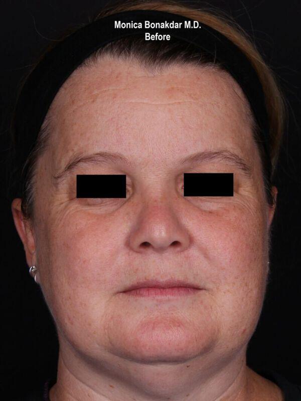 Injectable Treatments Before & After Photo