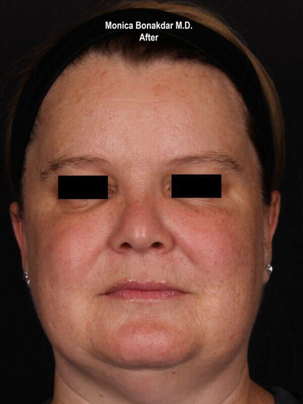 Injectable Treatments Before & After Photo