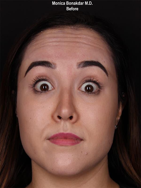 Injectable Treatments Before & After Photo