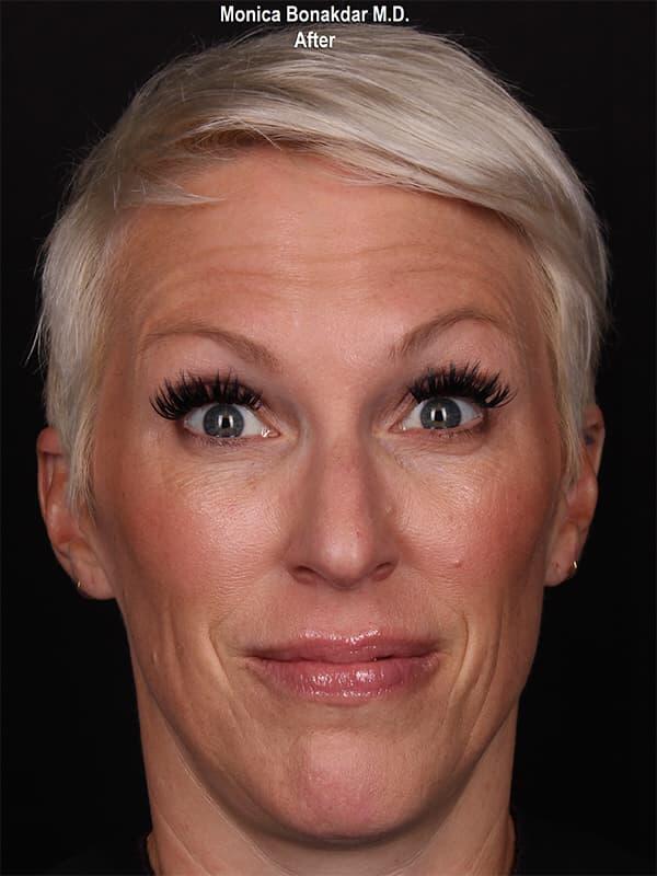 Injectable Treatments Before & After Photo