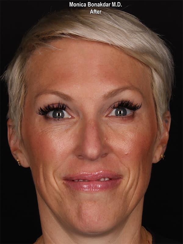 Injectable Treatments Before & After Photo
