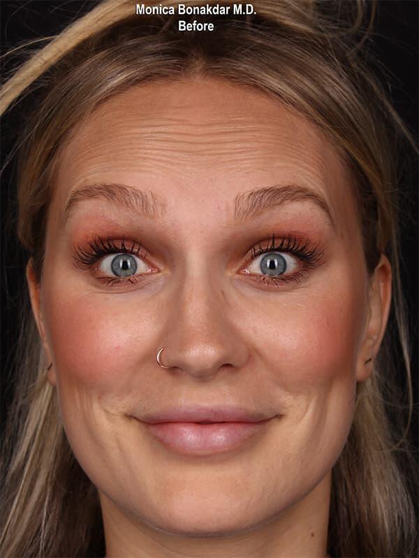 Injectable Treatments Before & After Photo