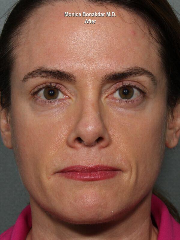 Injectable Treatments Before & After Photo