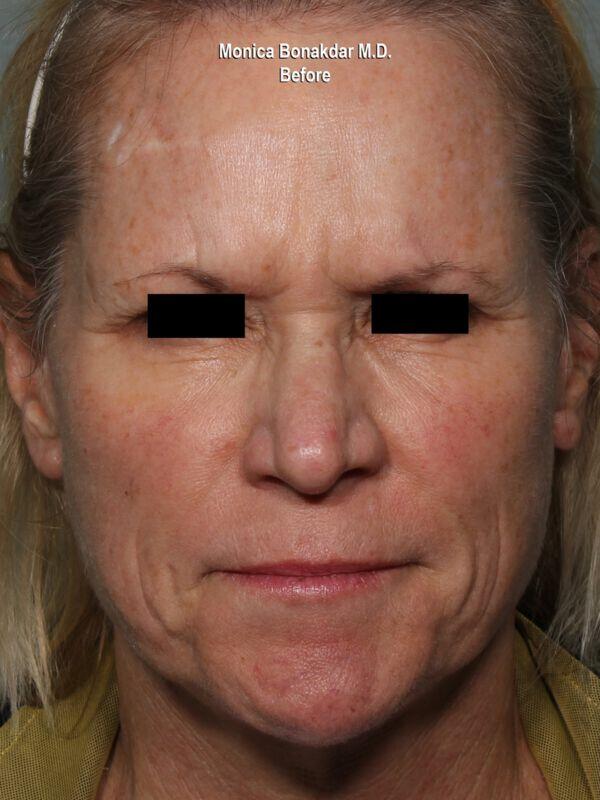 Injectable Treatments Before & After Photo