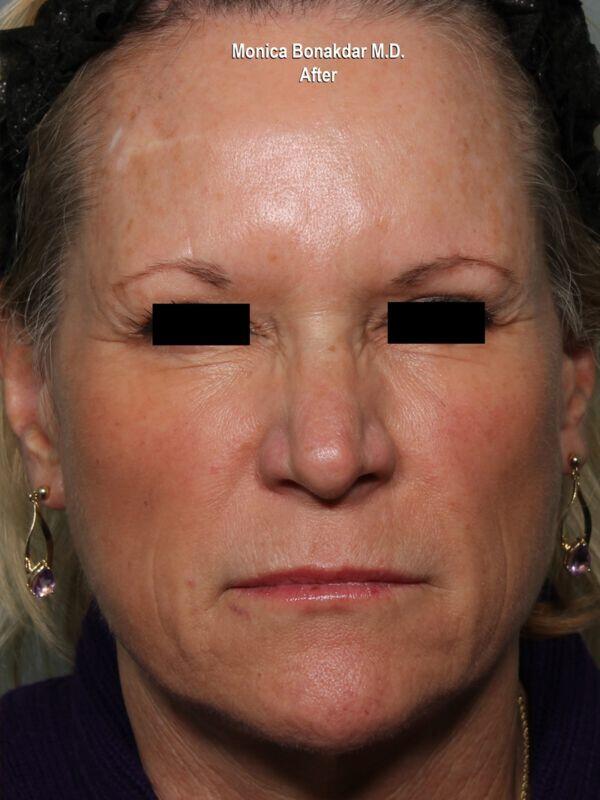 Injectable Treatments Before & After Photo