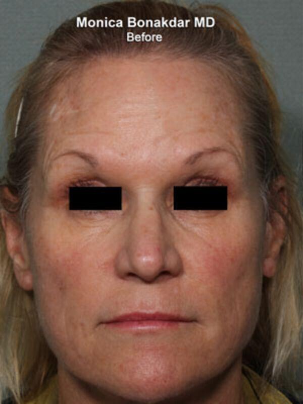 Injectable Treatments Before & After Photo