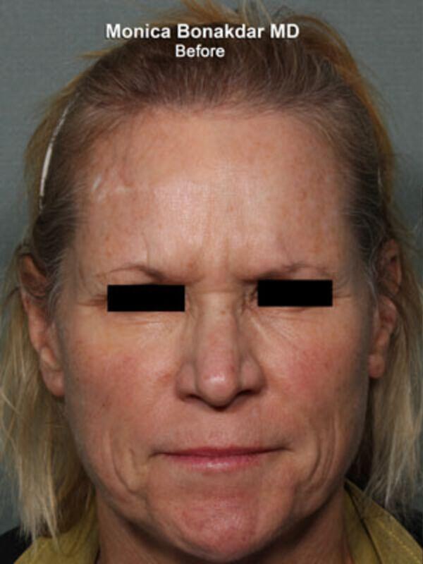 Injectable Treatments Before & After Photo