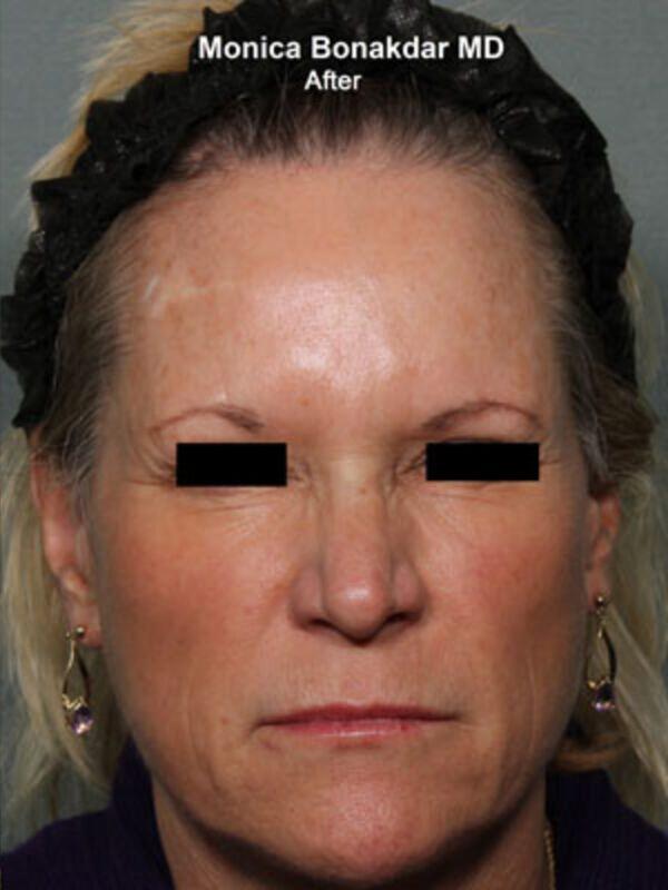 Injectable Treatments Before & After Photo