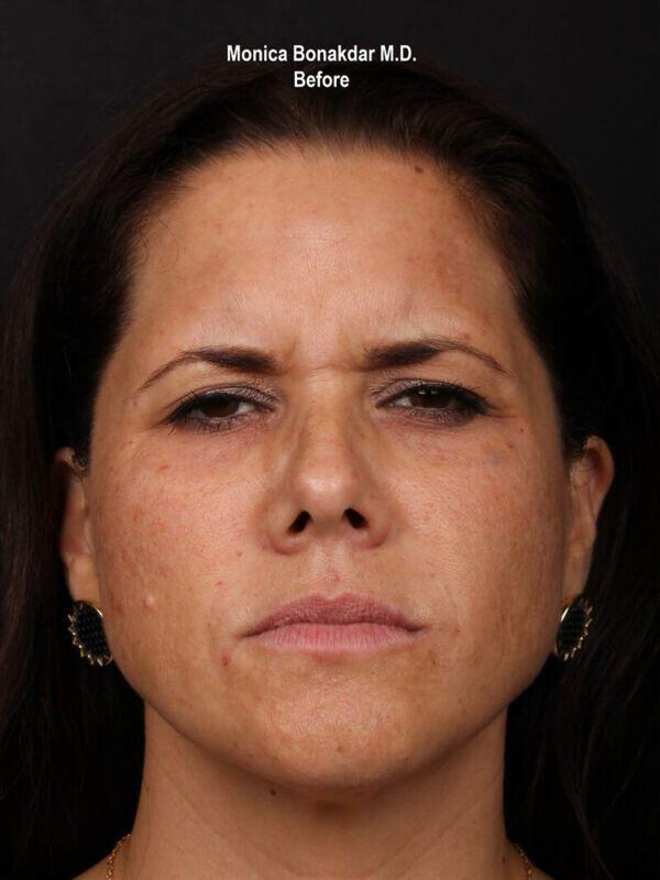Injectable Treatments Before & After Photo