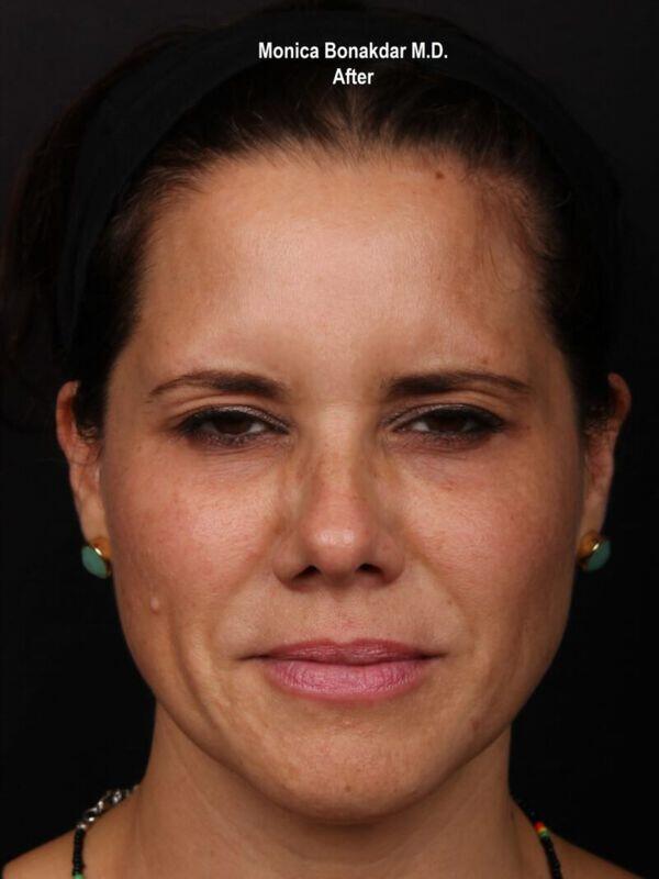 Injectable Treatments Before & After Photo