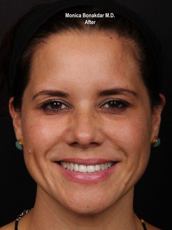 Injectable Treatments Before & After Photo