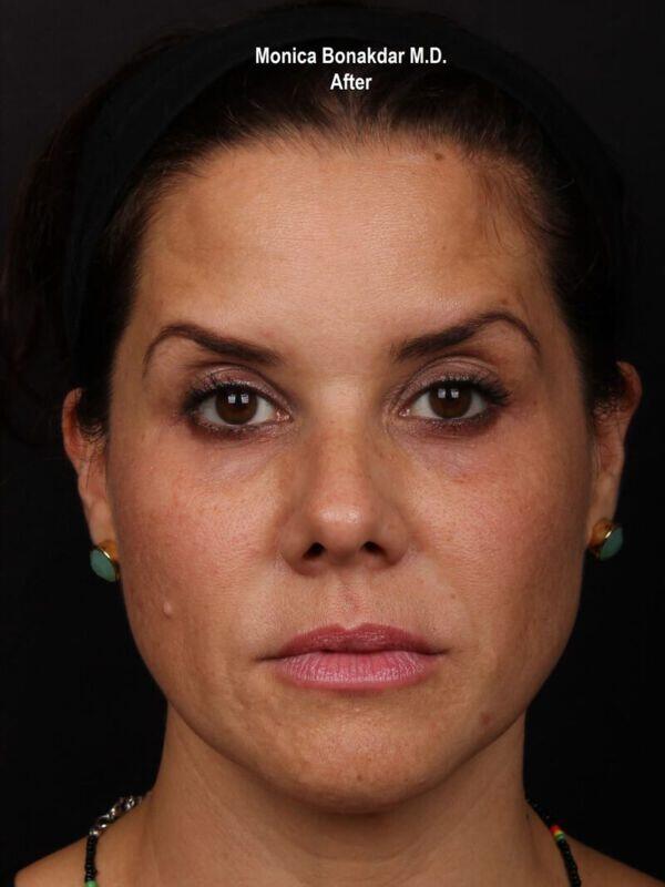 Injectable Treatments Before & After Photo