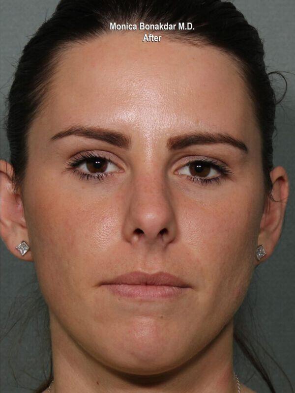 Injectable Treatments Before & After Photo