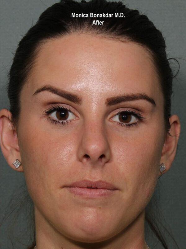 Injectable Treatments Before & After Photo