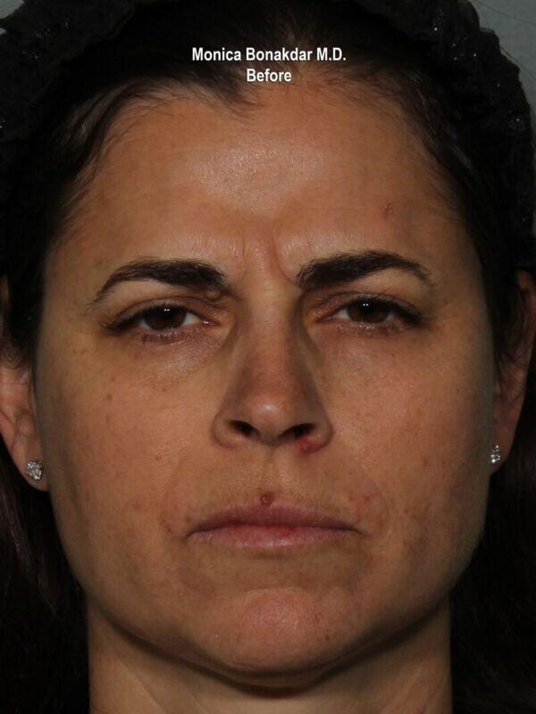 Injectable Treatments Before & After Photo