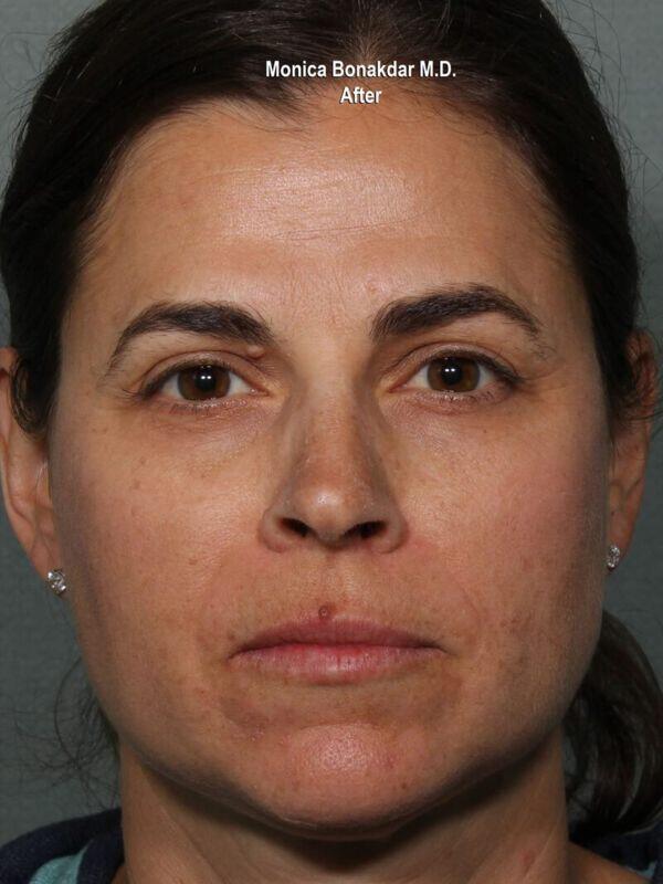 Injectable Treatments Before & After Photo