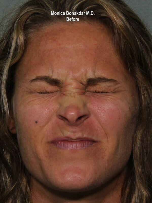 Injectable Treatments Before & After Photo