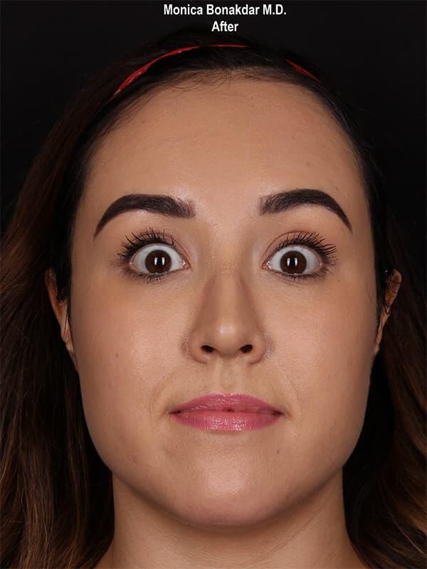 Injectable Treatments Before & After Photo