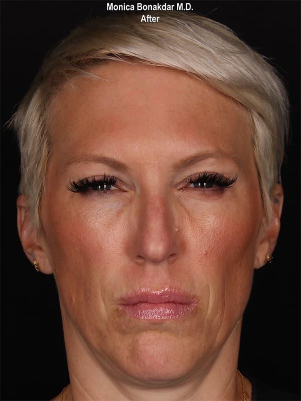 Injectable Treatments Before & After Photo