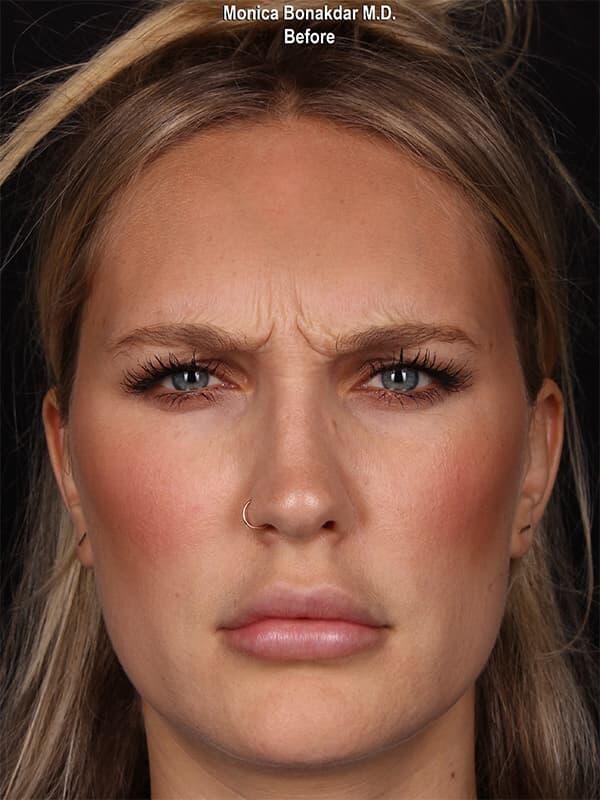 Injectable Treatments Before & After Photo