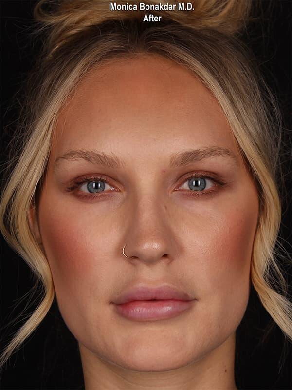 Injectable Treatments Before & After Photo