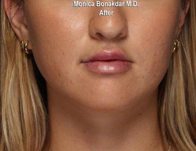 Dramatic Lip Enhancement Before & After Photo