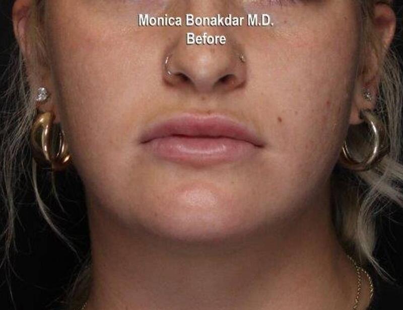 Dramatic Lip Enhancement Before & After Photo