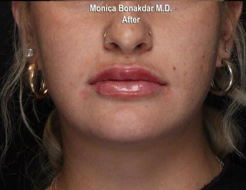 Dramatic Lip Enhancement Before & After Photo