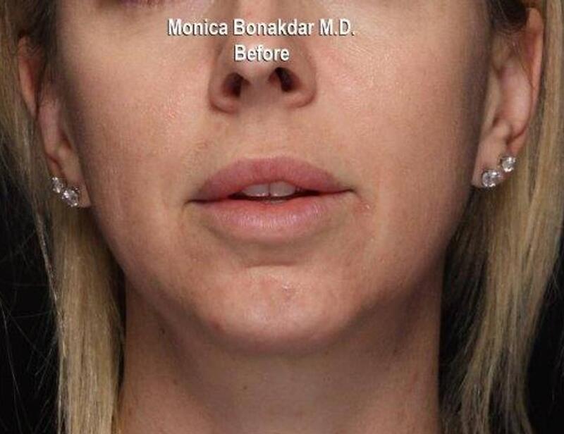 Dramatic Lip Enhancement Before & After Photo