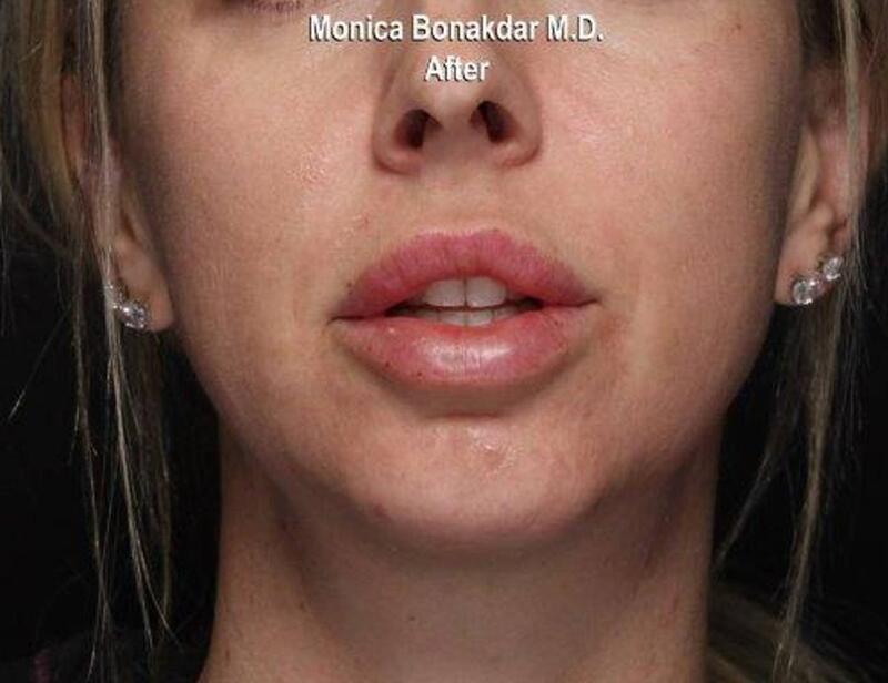 Dramatic Lip Enhancement Before & After Photo