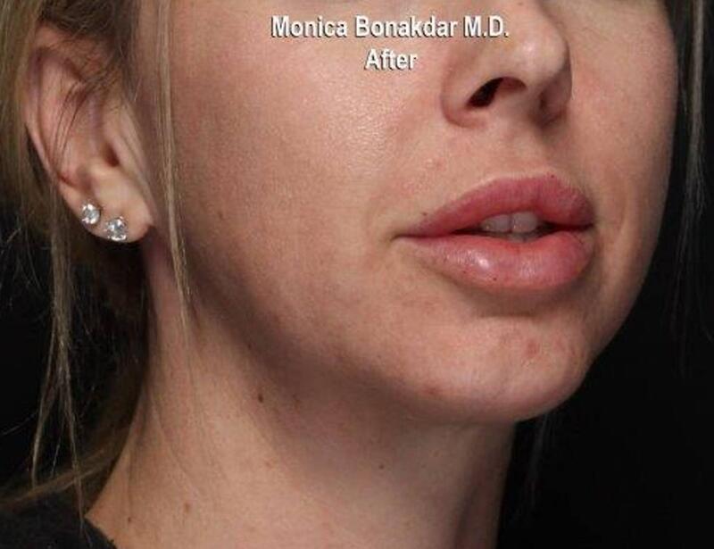 Injectable Treatments Before & After Photo