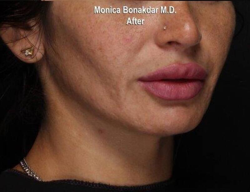 Dramatic Lip Enhancement Before & After Photo